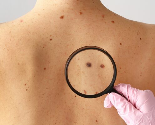 Dermatologist performs melanoma screening, skin check.