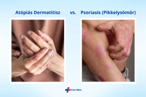 Illusztráció az atópiás dermatitis és a psoriasis tüneteinek szemléltetéséhez.