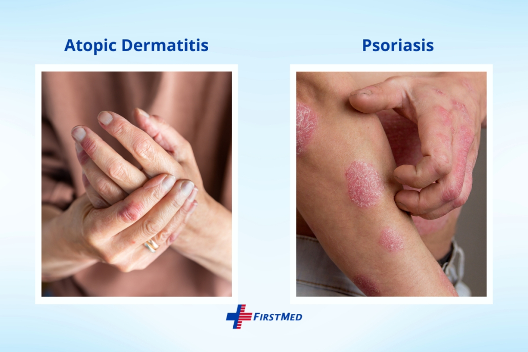 Image that illustrates the difference between atopic dermatitis and psoriasis