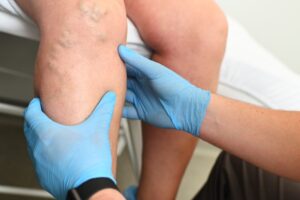 phlebologist examines a patient with varicose veins on his leg, varicose veins treatment