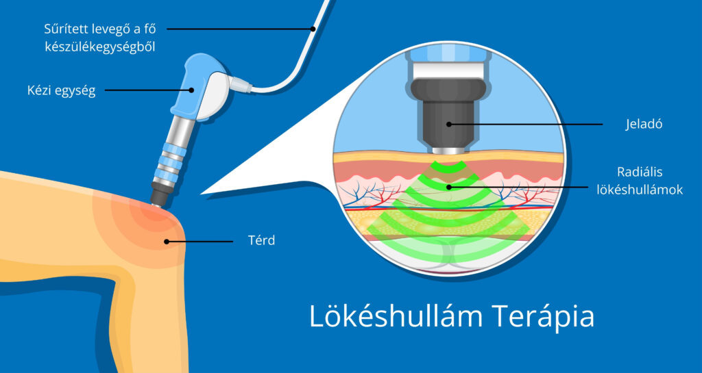 Lökéshullám terápia működésének szemléltetése infografikán