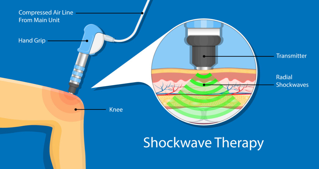 Shockwave therapy SWT physiotherapist treat muscular disorder back neck physical tennis Elbow muscle stimulator ultrasound calcific tendonitis