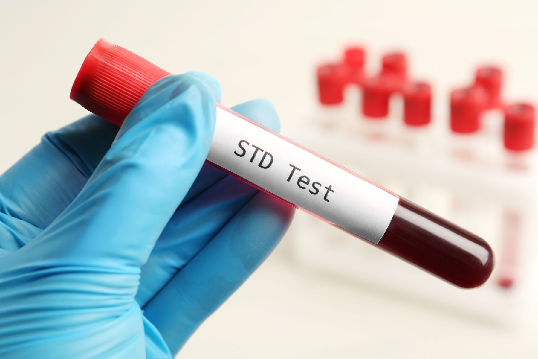 STD Lab Test